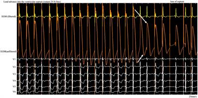 Case report: Left bundle branch pacing guided by real-time monitoring of current of injury and electrocardiography